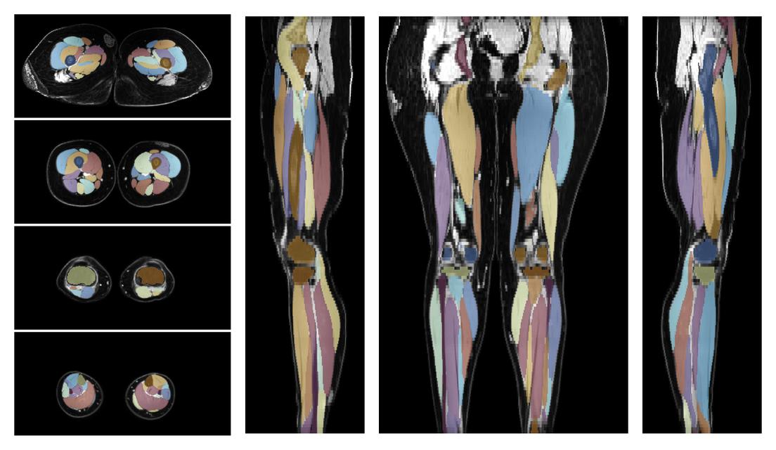 Overlay of automated muscle segmentation labels on dixon water image.